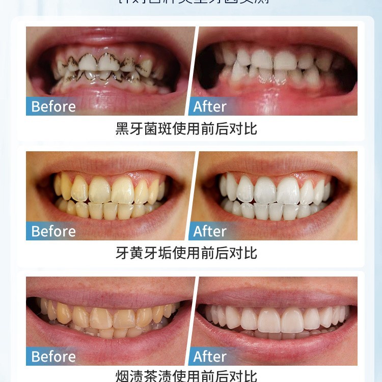 Spazzola per la rimozione dell - Teeth Whitening Japan recensione e prezzo
