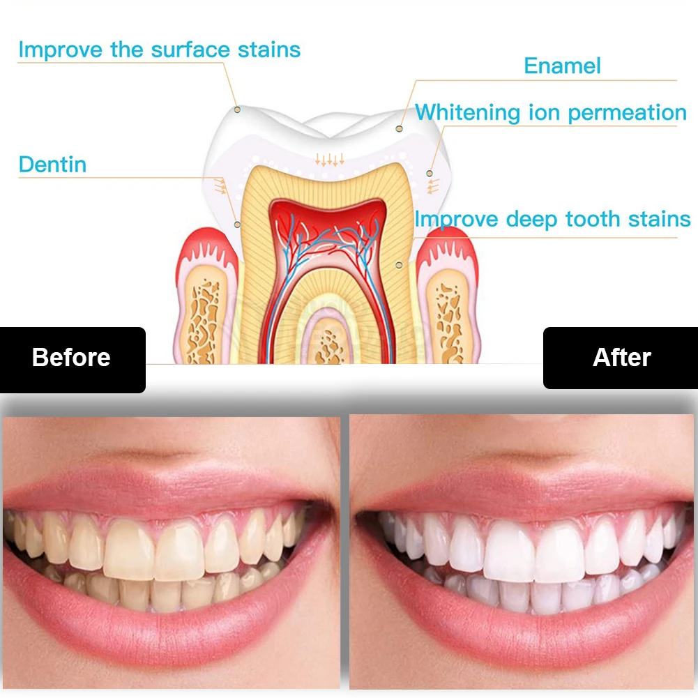 Kit per sbiancamento dei denti - Teeth Whitening With Trays recensione e prezzo
